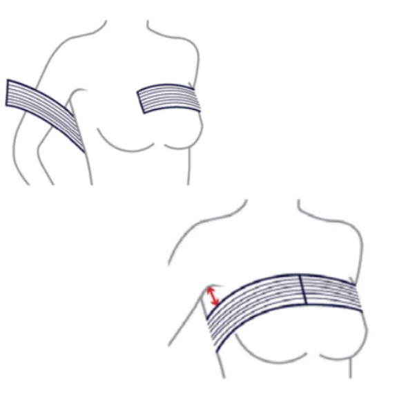 Postoperative Bandage für Brustvergrößerung - Optimale Kompression